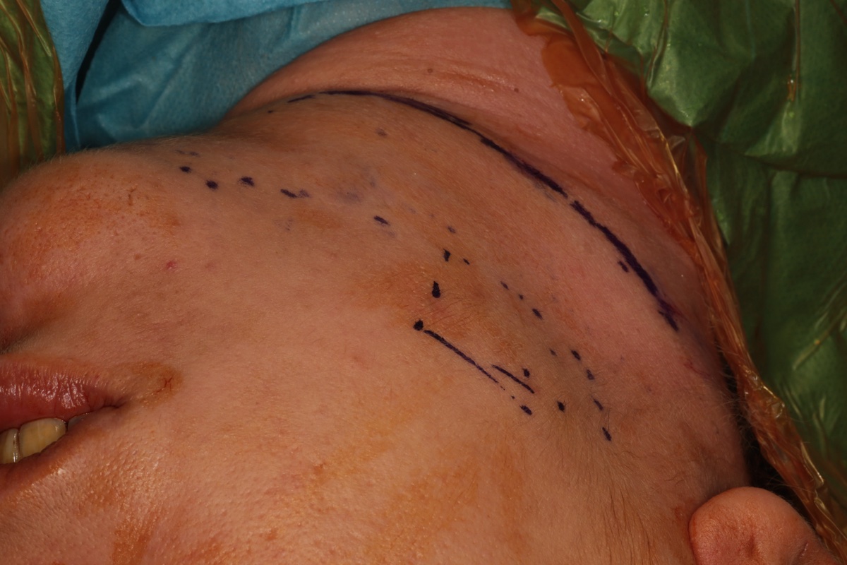 Preoperative surgical marking on mandible