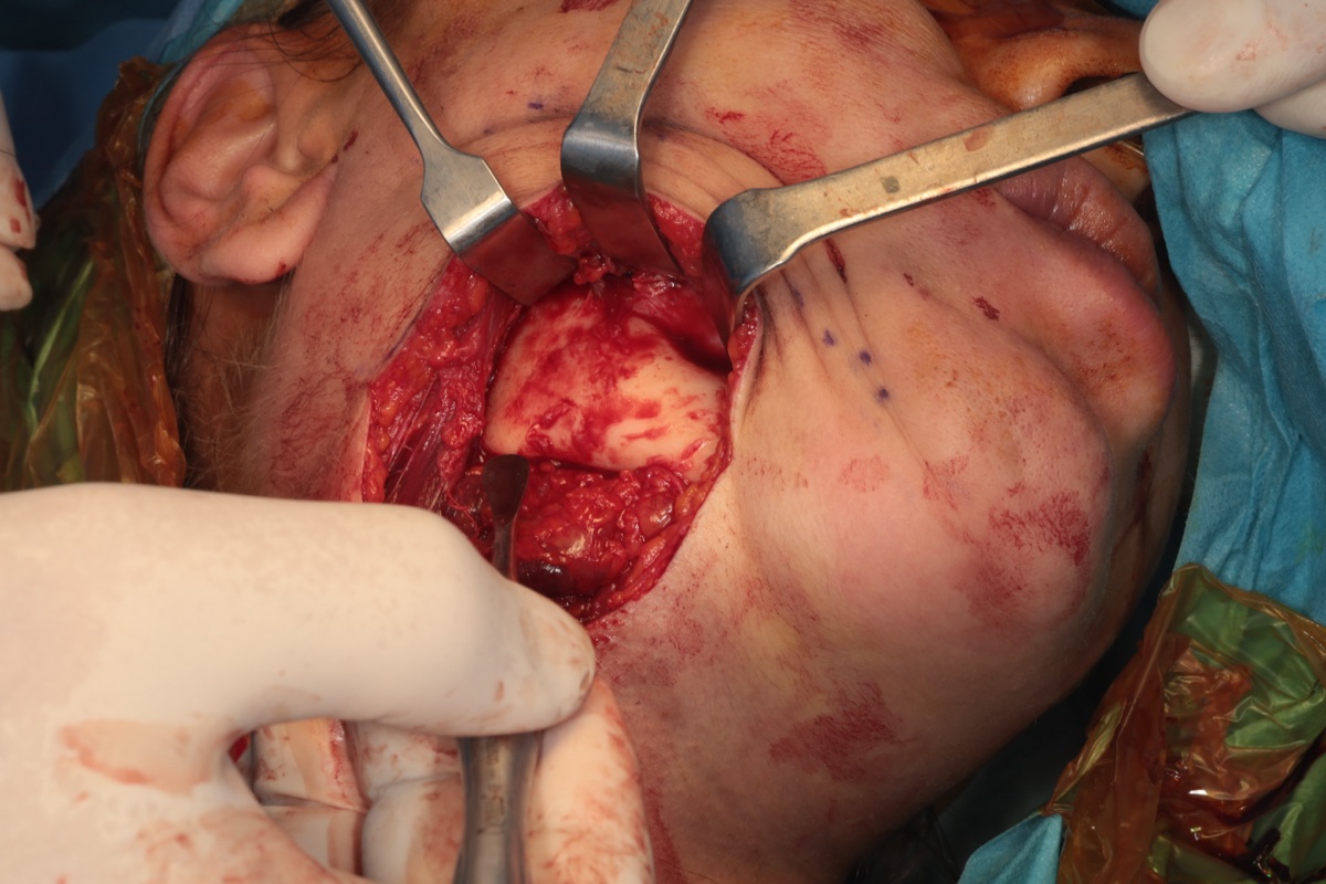 Mandibular body exposed through submandibular approach