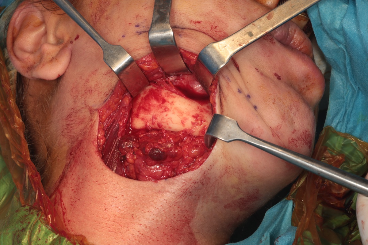 Intraoperative assessment of mandibular lesion