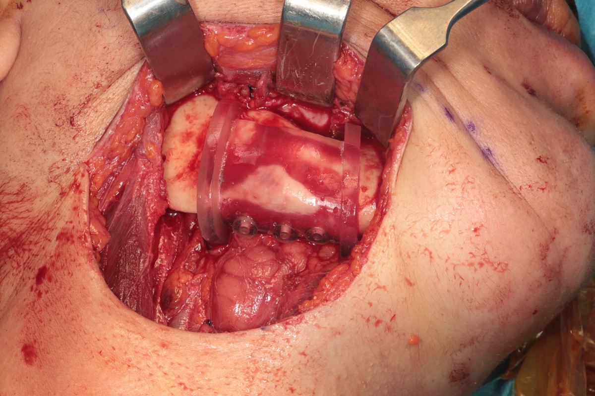 3D-printed cutting guide positioned on mandible