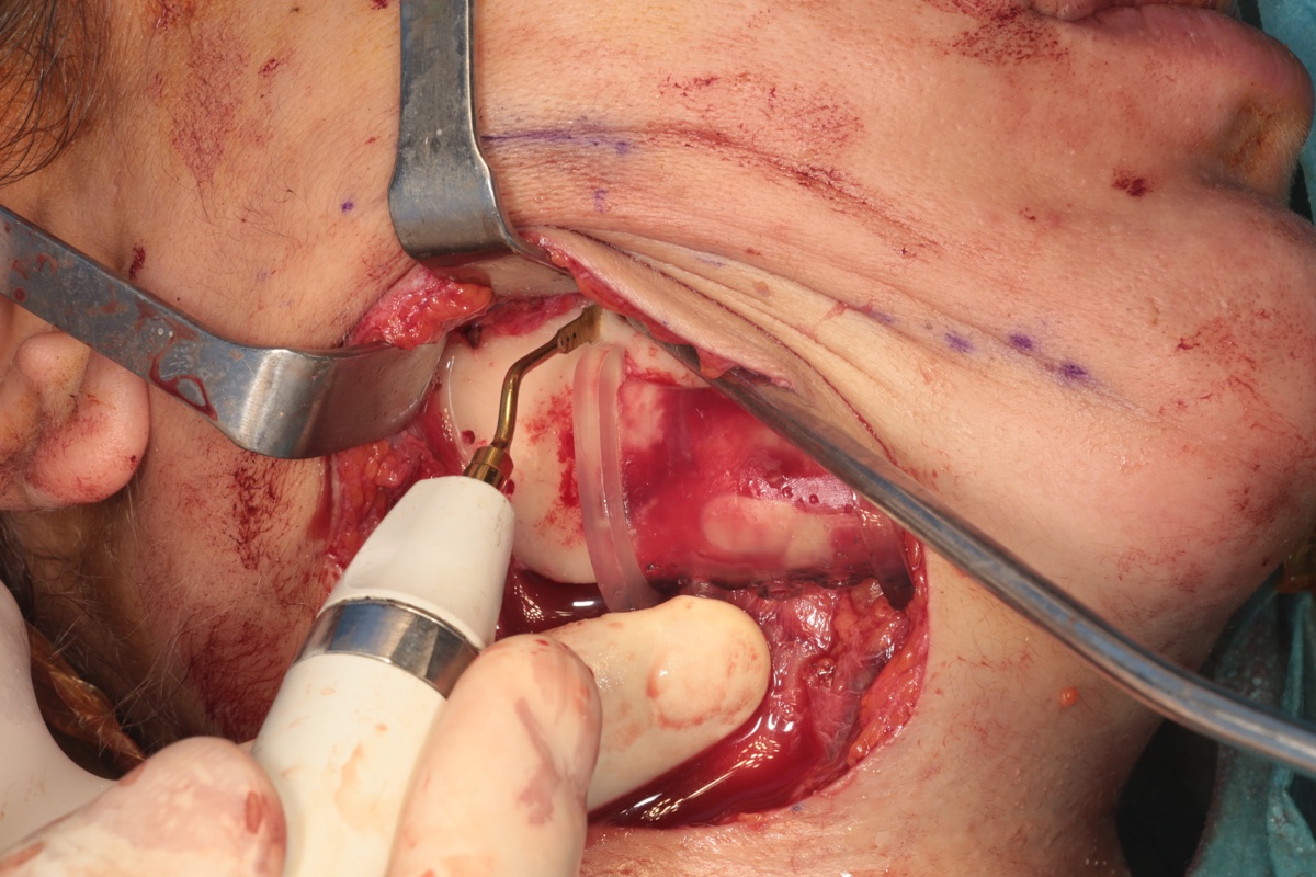 Piezoelectric osteotomy through cutting guide slots