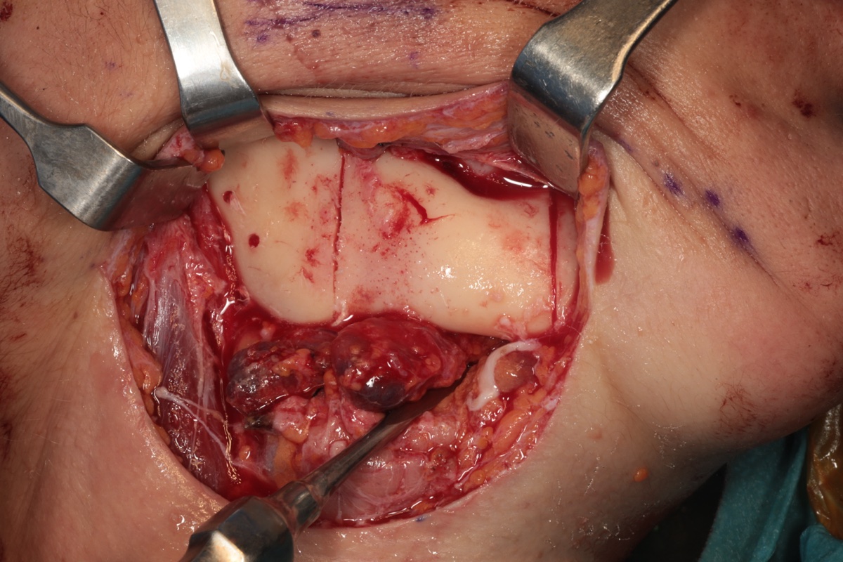 Post-resection mandibular defect with iliac crest bone graft