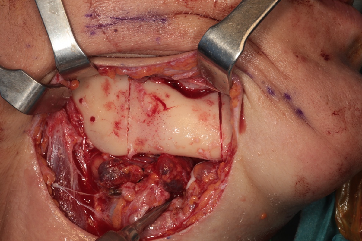 Osteotomy line with reconstruction plate adapted and secured