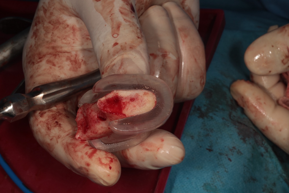 Cutting guide alongside resected mandibular bone specimen