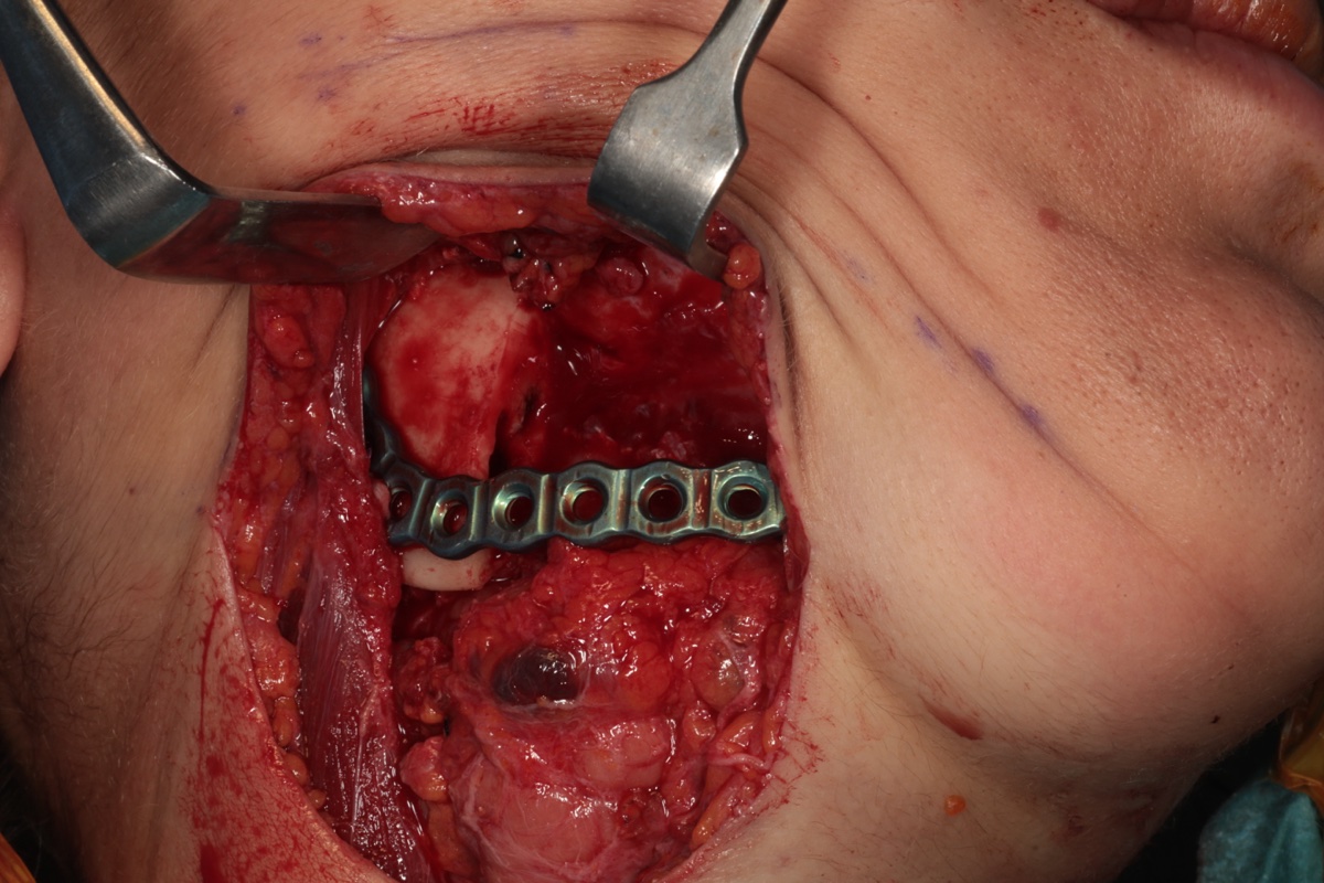 Titanium reconstruction plate fixed across mandibular defect