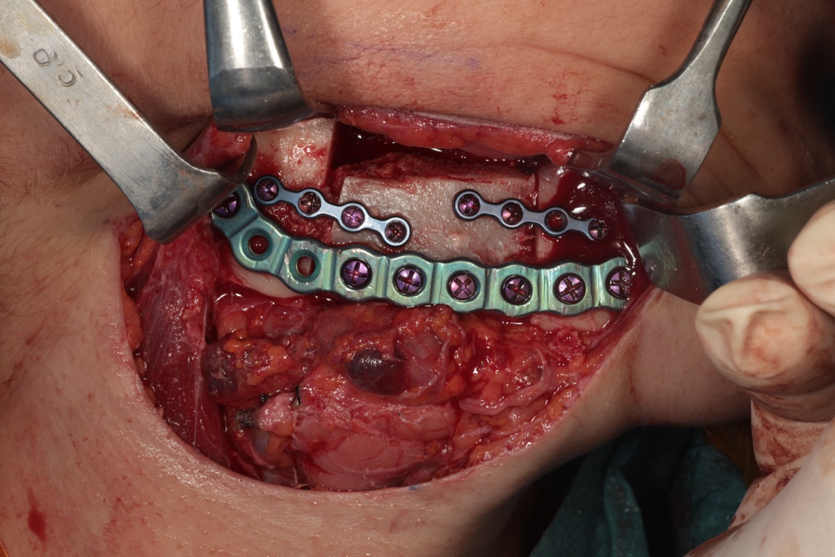 Dual titanium plate system for load-bearing stability