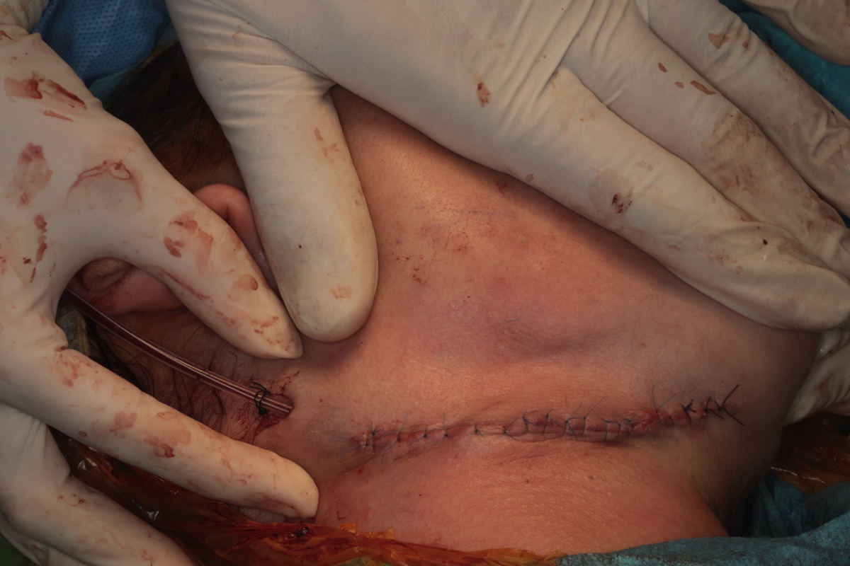 Primary wound closure with interrupted sutures