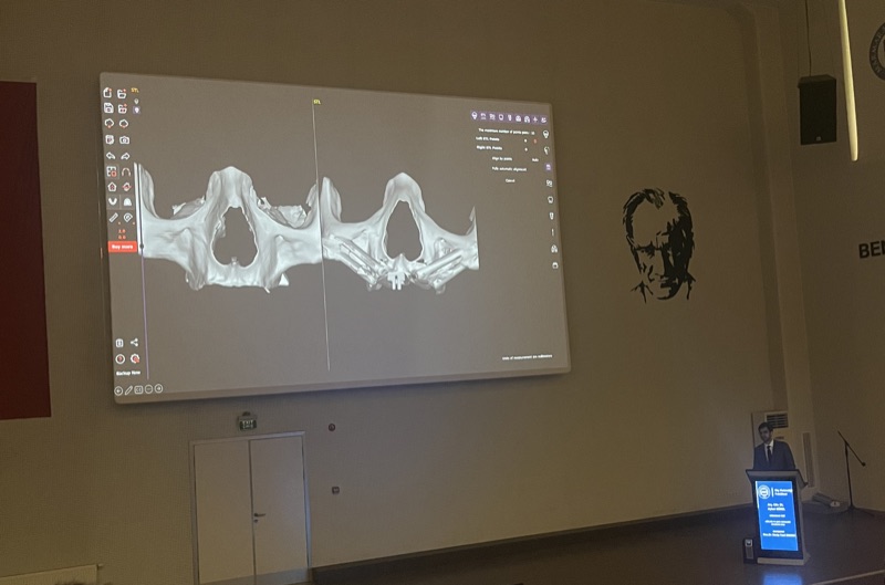 Zygomatic implant accuracy comparison — 3D surgical planning presentation